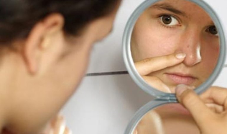 Permasalahan jerawat pada wanita