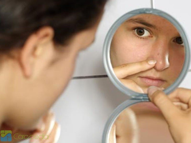 Permasalahan jerawat pada wanita