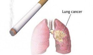 ciri-ciri-kanker-paru-paru